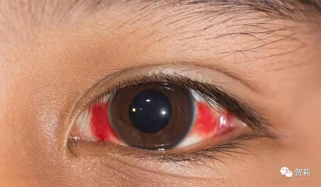 白眼球结膜下出血,结膜下出血是脑溢血前兆吗