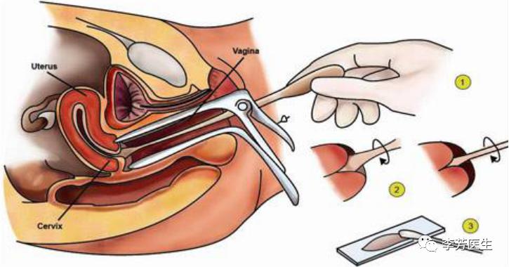 专家谈宫颈癌视频,权威专家谈宫颈癌病变怎样治疗