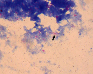 怀疑肺结核一定要查三次痰吗,医生怀疑是肺结核的几率有多大