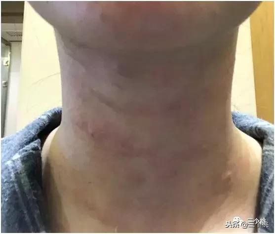 医美去颈纹全过程,去颈纹医美过程