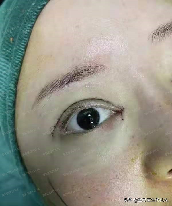 眼综合眼袋手术恢复全过程,眼周年轻化和祛眼袋