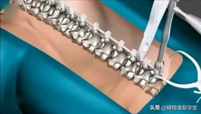 退行性脊柱侧凸的危害,退行性脊柱炎如何锻炼身体