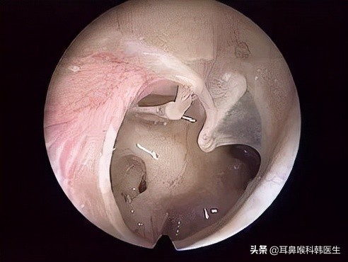 外伤鼓膜穿孔发炎怎么治,耳鼓膜穿孔怎么治