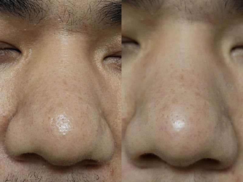 吸附黑头清洁面膜怎么用,清洁面膜黑头闭口