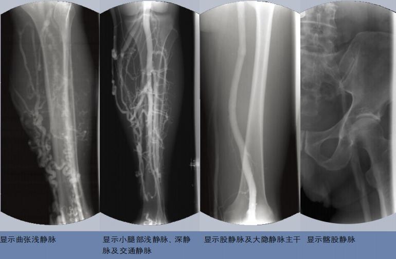 下肢静脉曲张最佳锻炼方法,关于下肢静脉曲张护理诊断