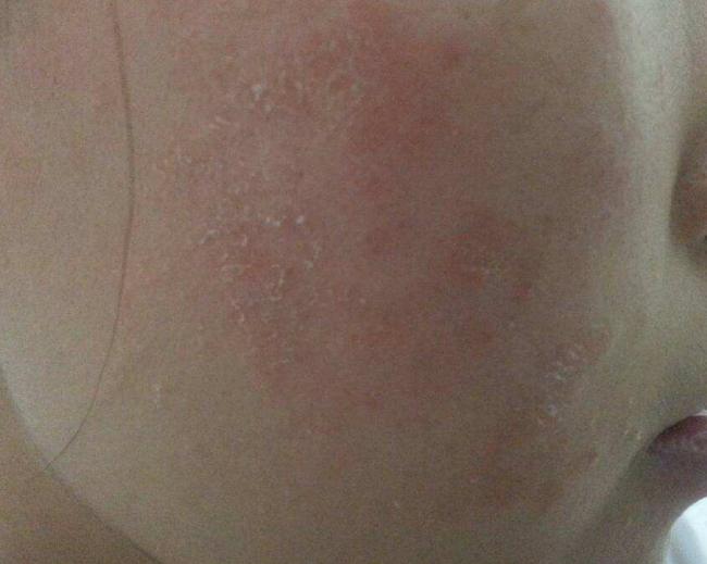 脸上发红发痒肿小妙招,脸上皮肤红痒怎么快速解决