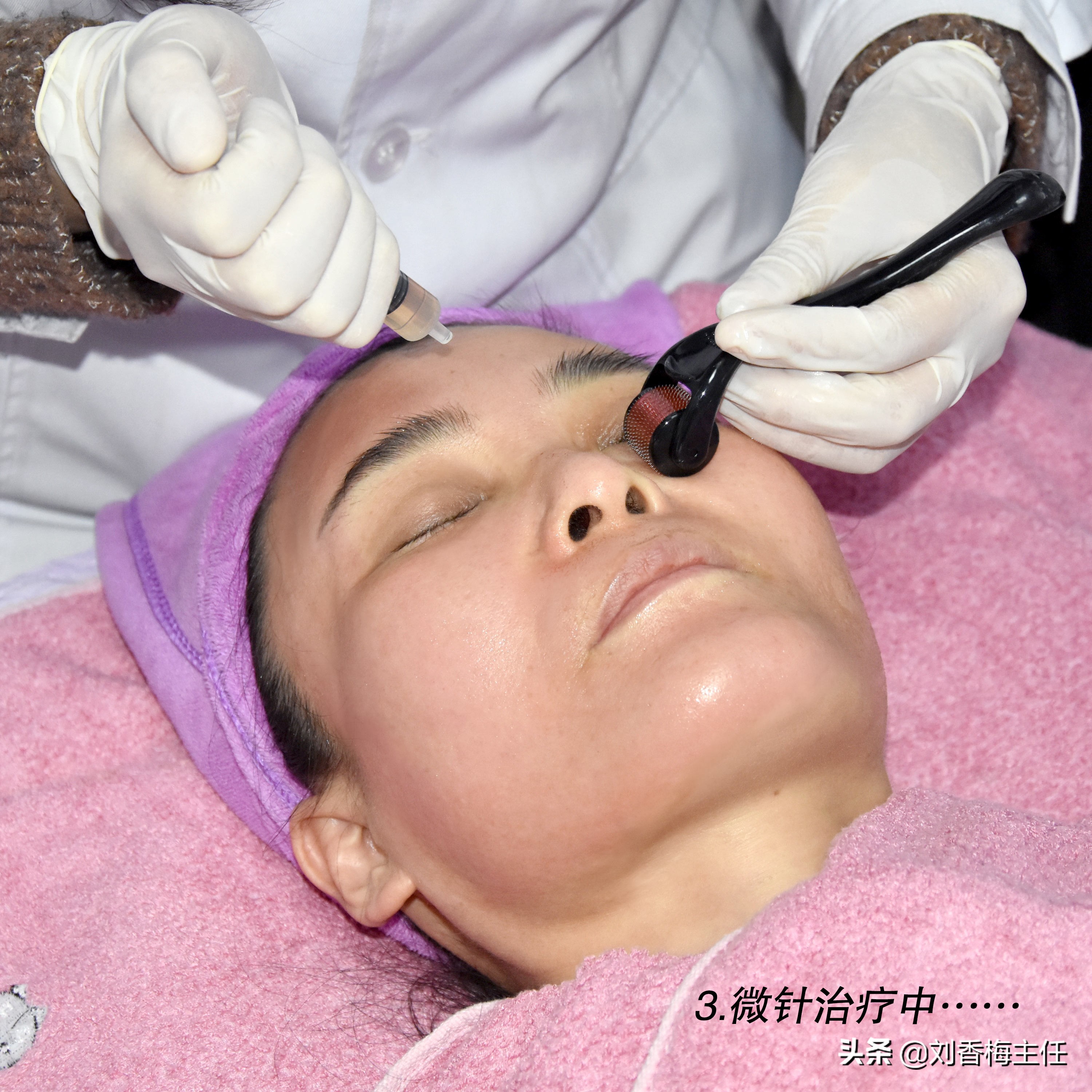 微针全解科普,微针到底有什么效果