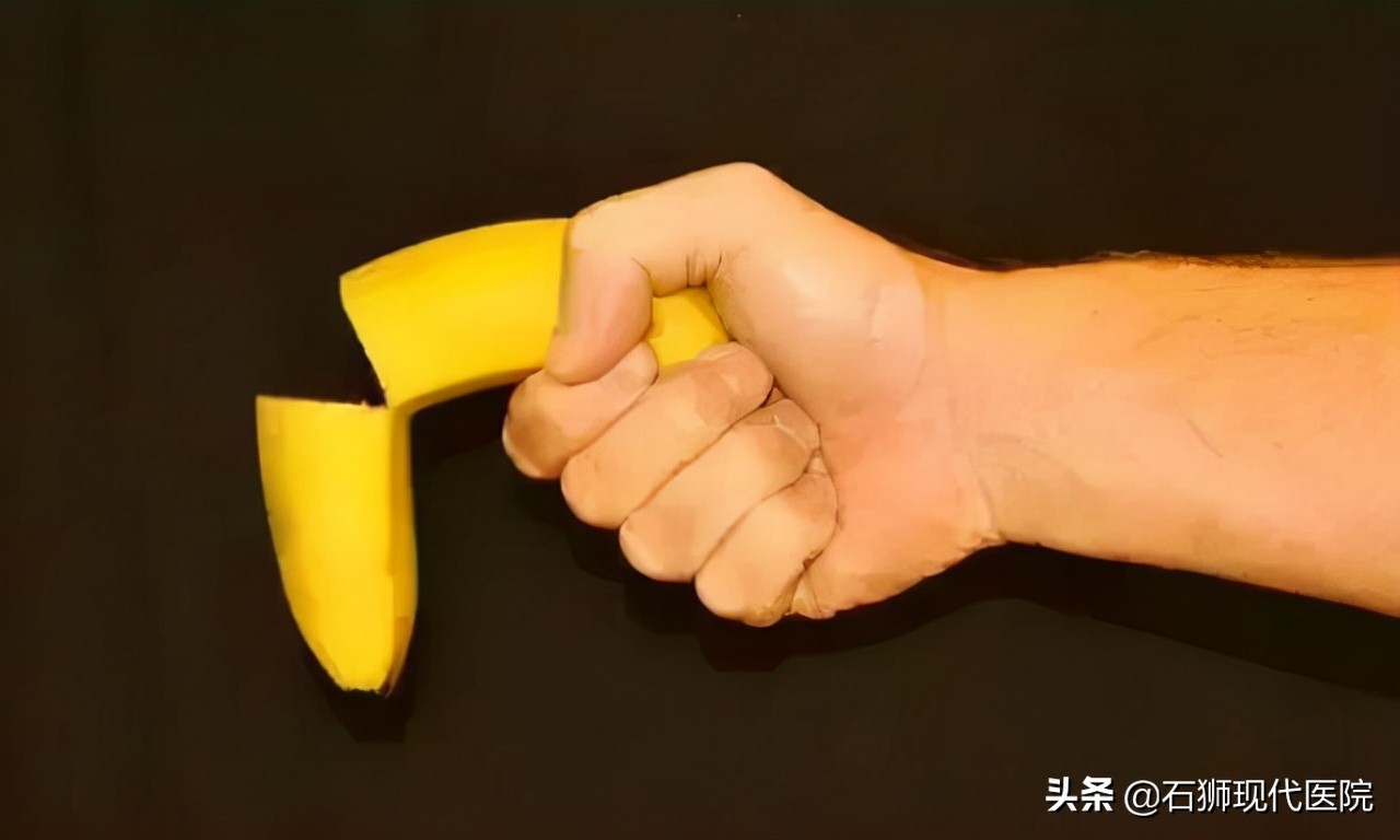 夫妻同房用力过猛致“丁丁折断”,石狮男科专家紧急手术为其修复