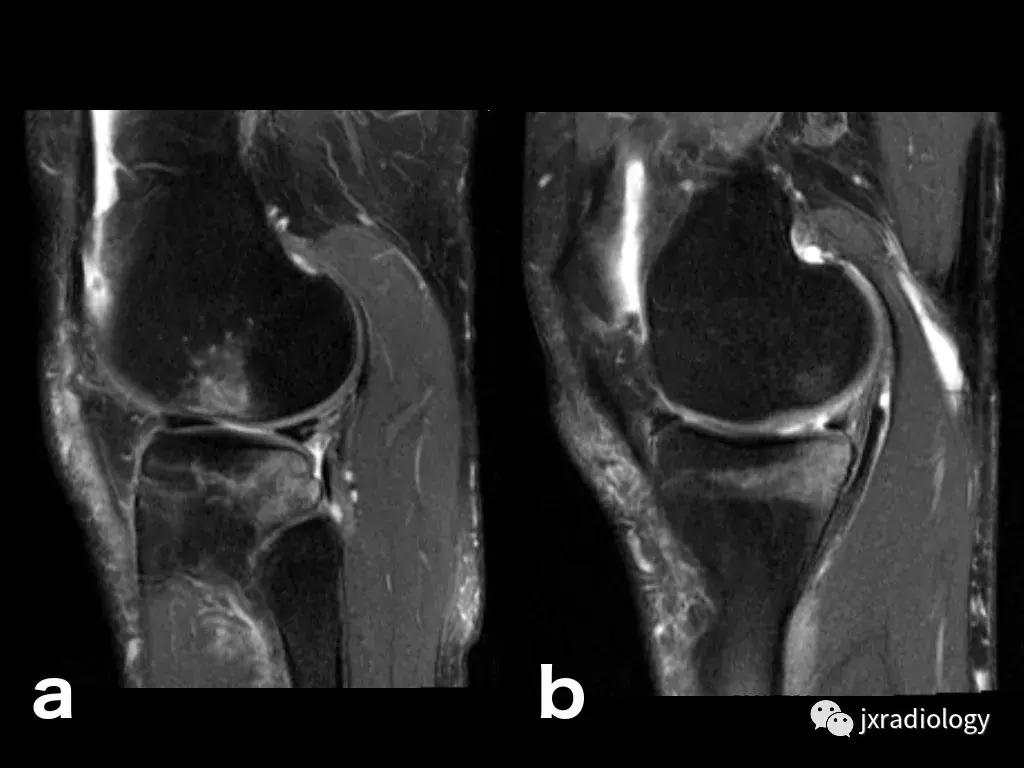 磁共振天天诊断骨髓水肿，但您知道原因吗？