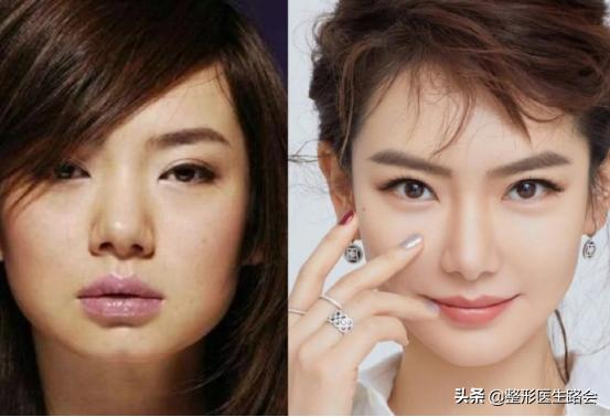 垫下巴手术流程,垫下巴手术的全过程