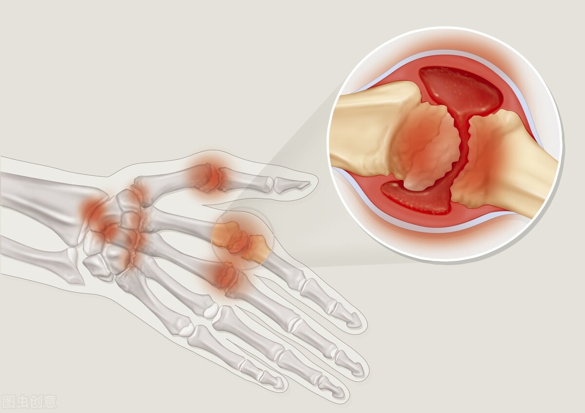 诊断类风湿的四个标准是什么,诊断类风湿关节炎的六条指标