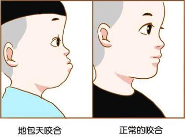 牙齿矫正地包天矫正器图片,牙齿矫治器地包天