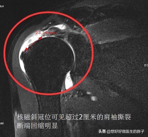 左侧肩膀疼痛预示十种病,哪些病可引起肩膀痛后背痛颈椎痛