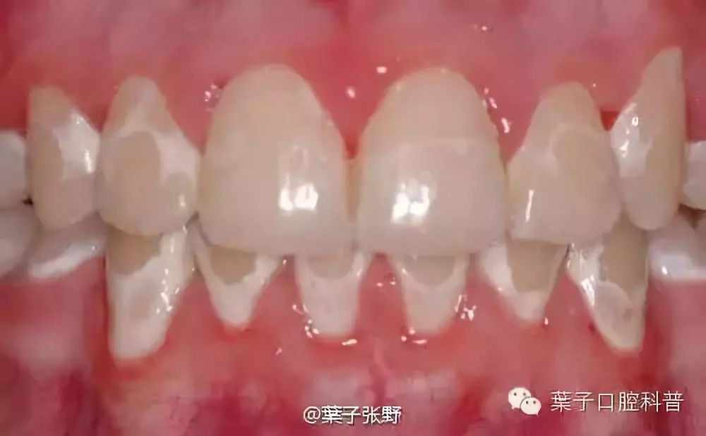 蛀牙下的牙龈有白色的小白点,牙齿有白斑是龋齿的前兆吗