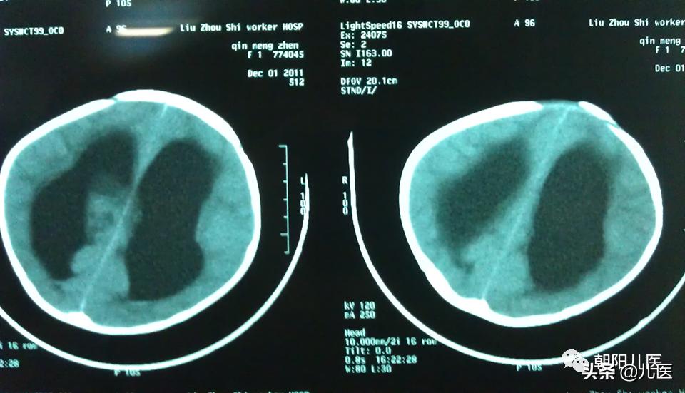 要是不打疫苗有事吗,不打疫苗对住院有影响么