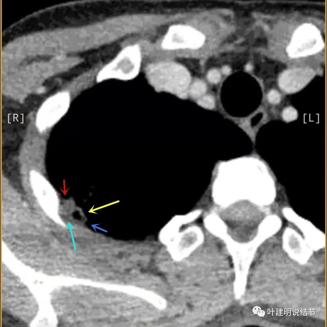 临床诊断孤立性肺结节,空洞型结节一般是什么性质