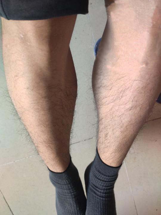 鱼鳞病18岁能恢复到正常人皮肤吗,24岁小伙鱼鳞病