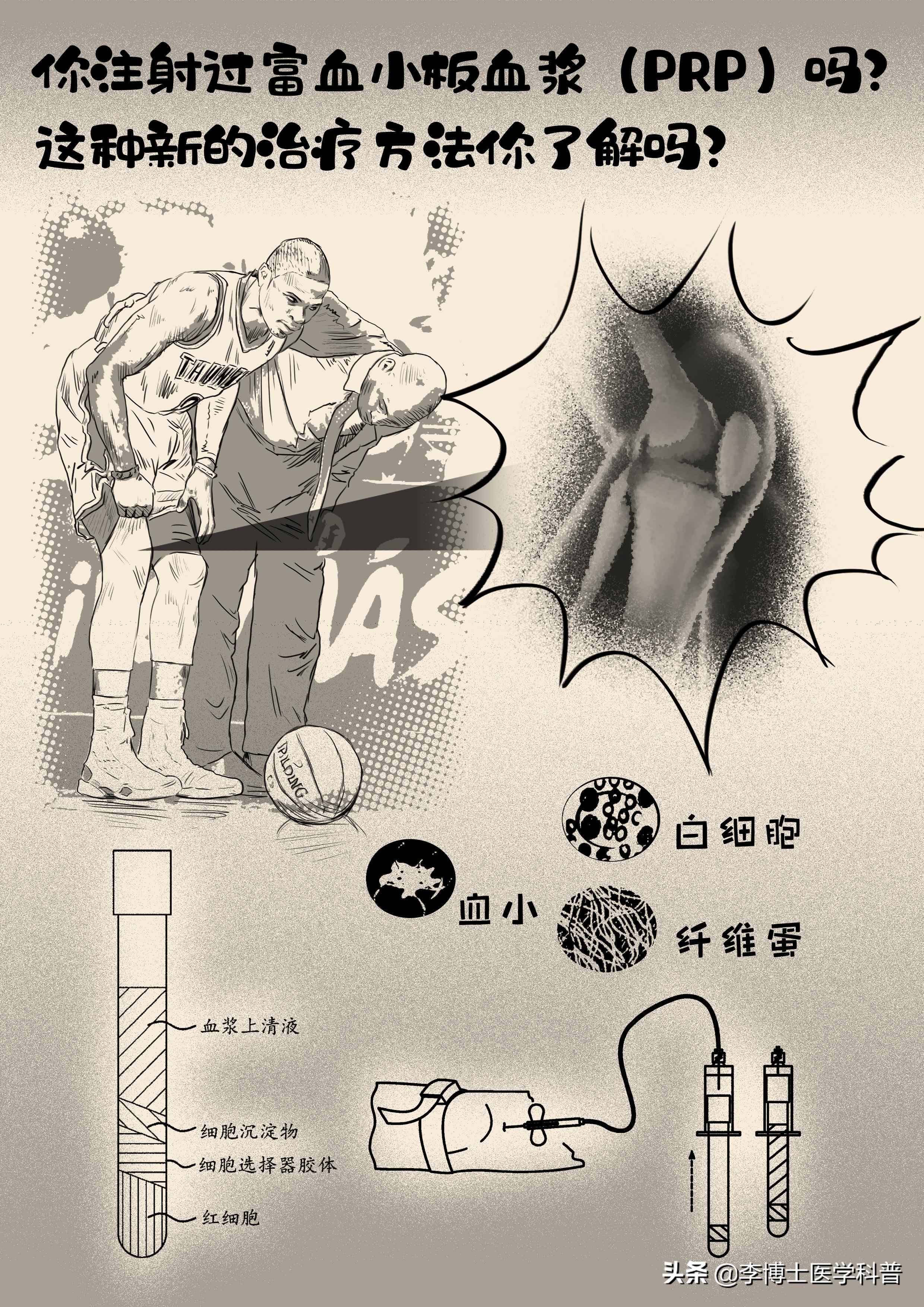 注射富血小板血浆会有疼痛呢,prp富血小板血浆疗法科普