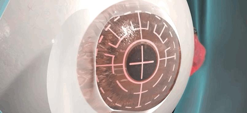 激光治疗近视什么原理,激光矫正是什么原理