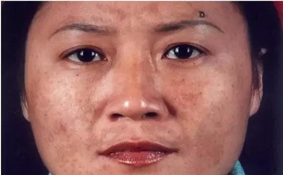 祛斑面诊必背知识点,要祛斑