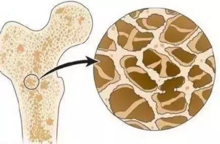 骨质疏松的药副作用,诊断为骨质疏松病人最大危险因素