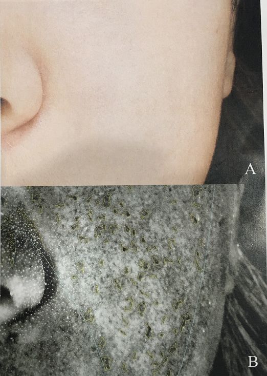 拯救毛孔粗大测评,毛孔粗大拯救全过程