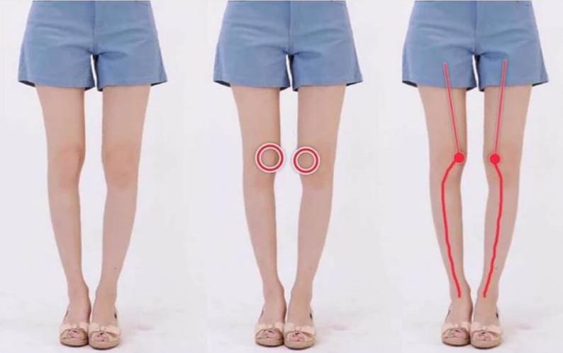 o型腿怎么走路有助于变直,成人o型腿最快变直的方法