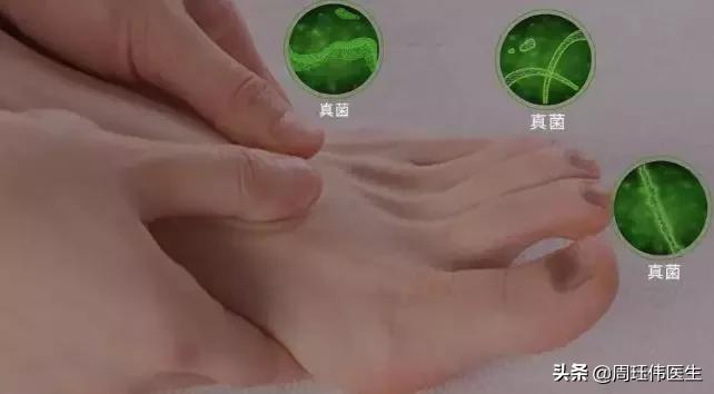 灰指甲和脚气哪个传染性强,疥疮和灰指甲哪个传染性强