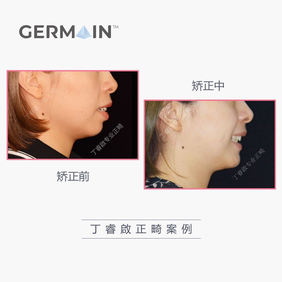 郑州牙齿矫正丁睿啟｜下巴后缩病例合集