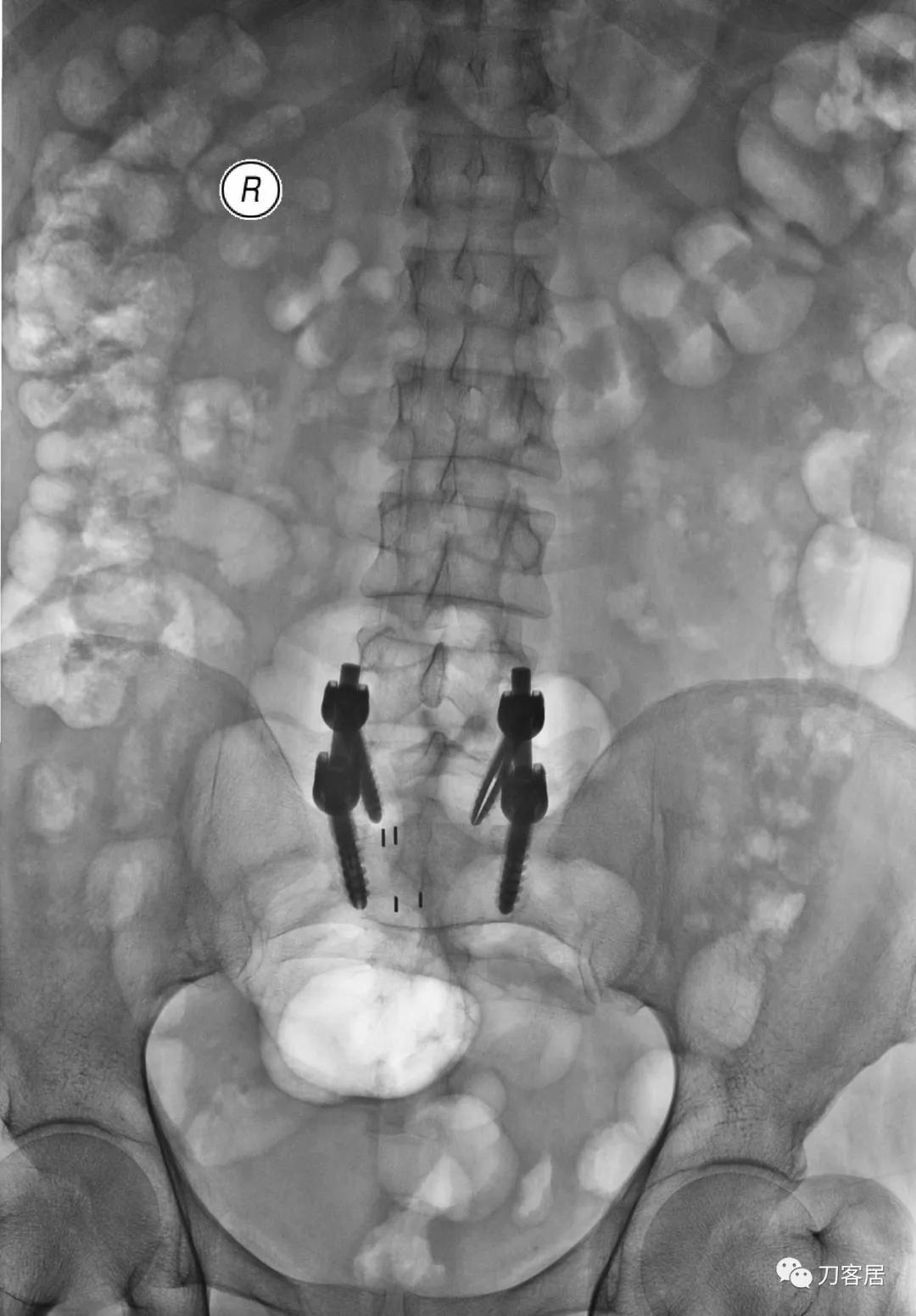 小针刀扎到坐骨神经会瘫痪吗,小针刀会切断坐骨神经吗