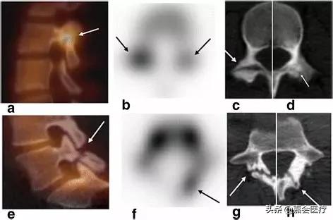 腰痛是不是因为驼背,腰两侧椎弓崩裂什么引起的