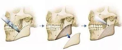 整容改脸型多少钱,女子花3万5整形结果