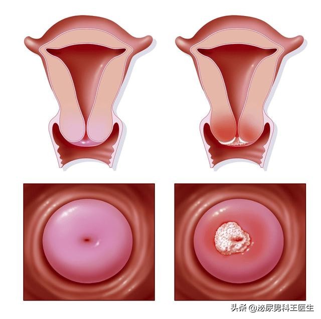 感染hpv病毒就会得宫颈癌吗,感染hpv得宫颈癌的几率