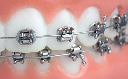 深圳正畸科医生口碑,正畸托槽掉了去诊所要收费吗