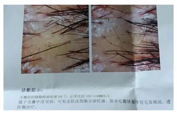 头油头痒还长小疙瘩用什么洗发水,头皮下长虫用什么药治疗