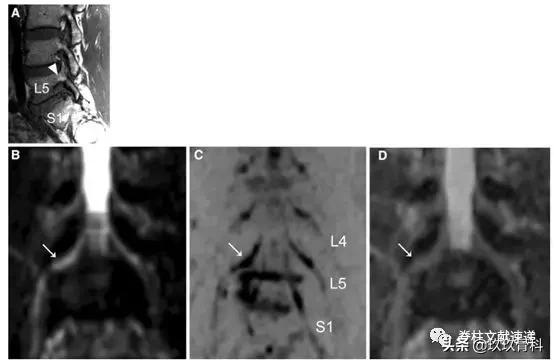 腰椎手术后神经根水肿要怎样治疗,腰椎融合术后神经根水肿吃中药