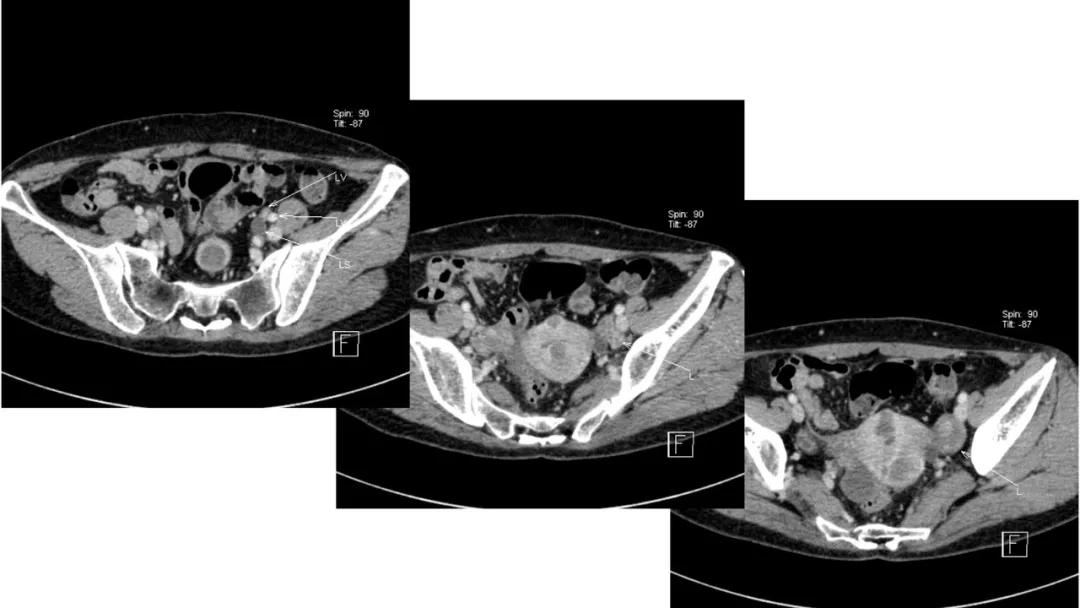 卵巢原发肿瘤的分析思路