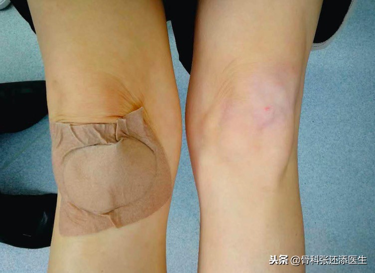 膝关节疼痛贴药贴贴在什么位置,关节疼痛贴膝盖贴管用吗