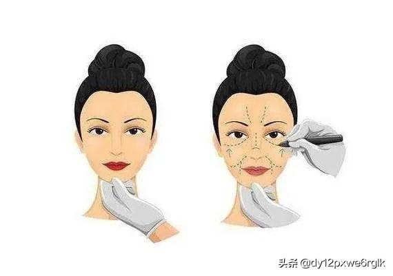 内窥镜小切口面部除皱术,内窥镜除皱术