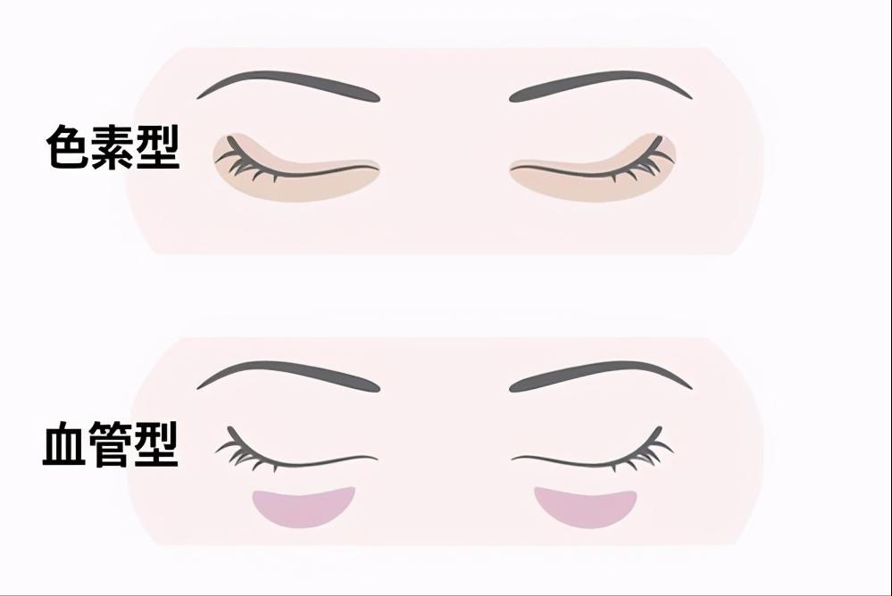 医学博士说眼霜真的治疗黑眼圈吗,真正对黑眼圈有用的眼霜