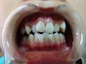 牙齿矫正一定要拔牙吗不拔可以吗,儿童牙齿矫正要拔牙吗