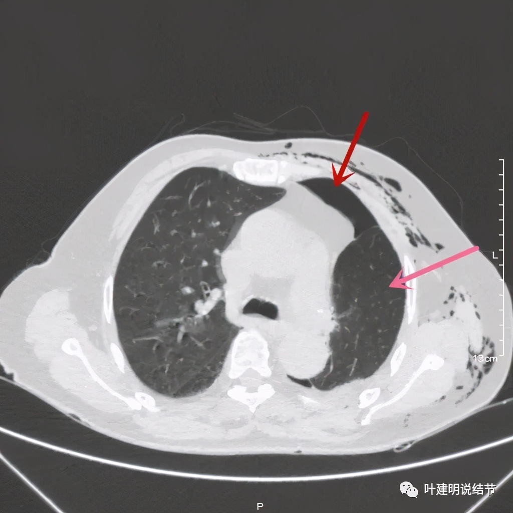 中央型肺癌手术前辅助治疗,中央型肺癌治疗后活过10年的病例