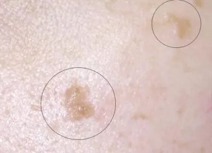 不痒不过敏的疹子，是HPV感染？医生：3分钟科普扁平疣与宫颈癌