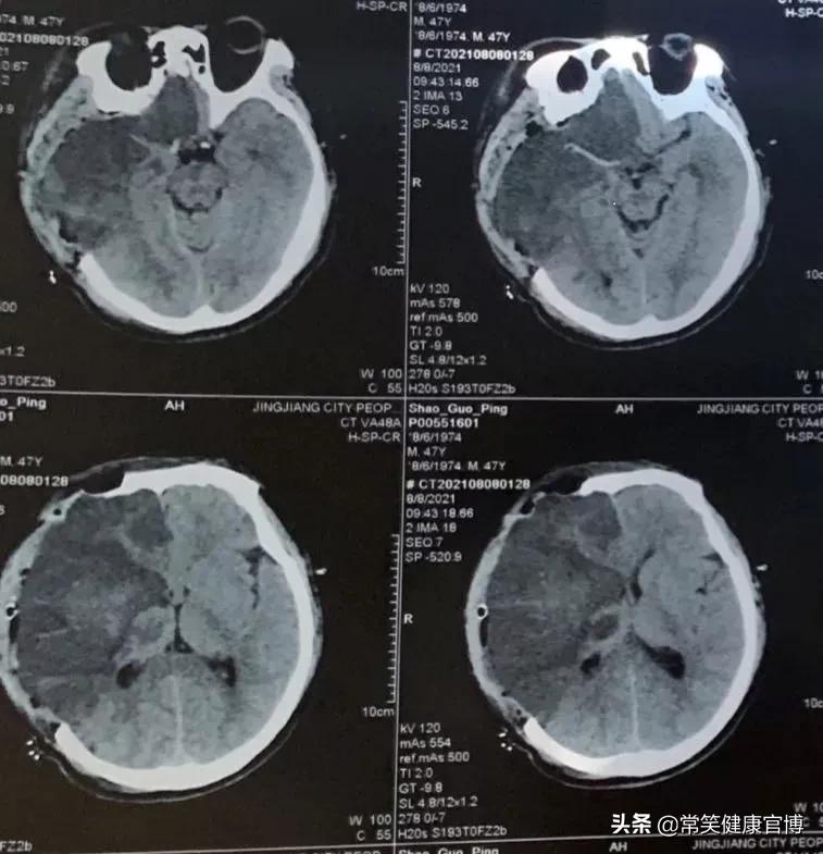 去骨瓣减压术后脑梗如何处理,去骨瓣减压术头骨如何恢复