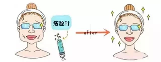郑州瘦脸针维持时间,瘦脸针后咬肌变化图