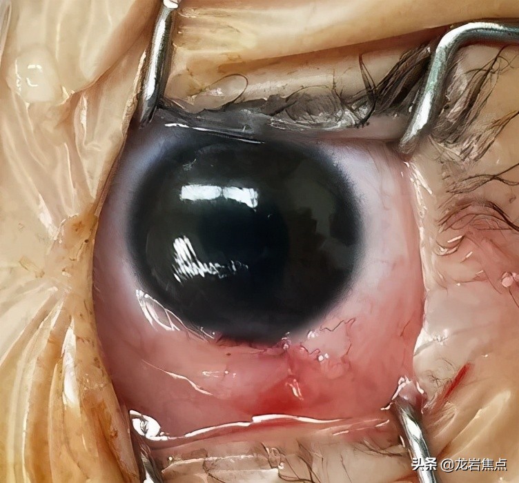 一岁小孩被公鸡啄伤后发生的事,男童被鸡啄伤