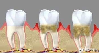 没有蛀牙就感觉有个洞,没有蛀牙但是隐约感觉有点牙疼