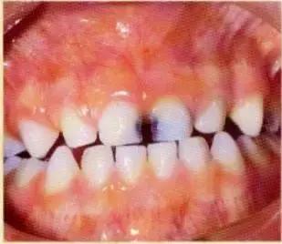 小黑点的蛀牙不严重吗,蛀牙了一点点黑色也得补么