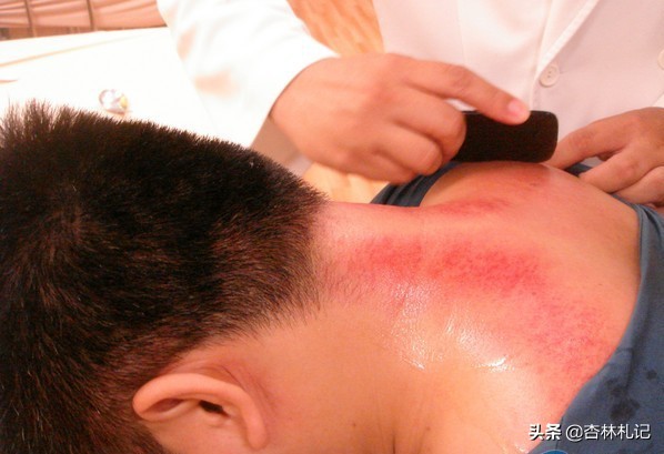 自己在家刮痧的正确方法图解,简述刮痧的操作方法