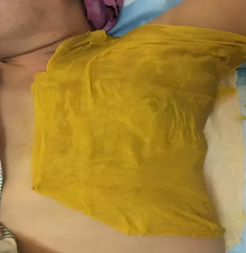 怎么治疗急性放射性皮炎,身上神经性皮炎很痒怎么办